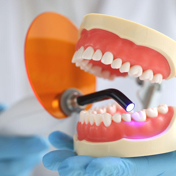 Dental fillings at Newmarket Dental